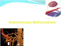 Bài giảng Arteriovenous Malformations - Trần Trọng Tài