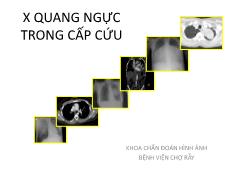 Bài giảng Xquang ngực trong cấp cứu